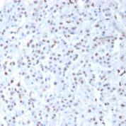 FFPE human mesothelioma sections stained with 100 ul anti-Wilms Tumor 1 (clone 6F-H2) at 1:200. HIER epitope retrieval prior to staining was performed in 10mM Citrate, pH 6.0.